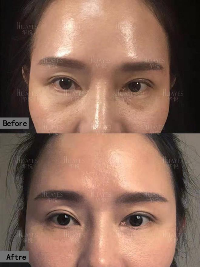 眼部青春光彩一键重启眼部青春魅力AYX爱游戏华悦白孝梅院长：重塑(图5)